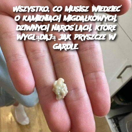 Wszystko, co musisz wiedzieć o kamieniach migdałkowych, dziwnych naroślach, które wyglądają jak pryszcze w gardle.