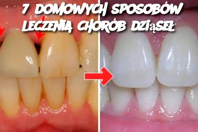 7 domowych sposobów leczenia chorób dziąseł